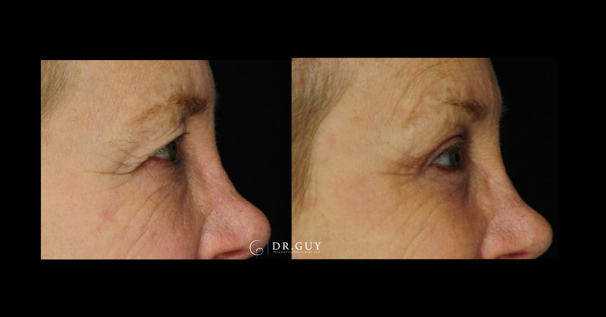 Browlift Before & After Gallery - Patient 185601 - Image 5