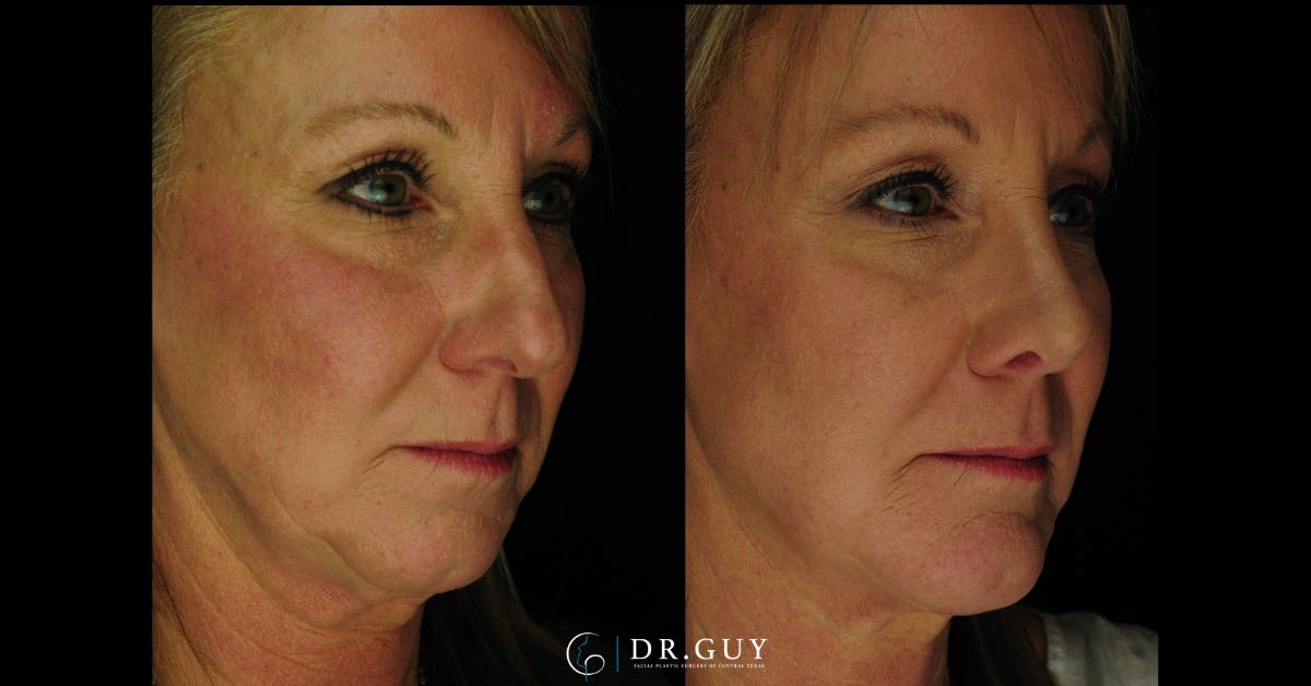 Surgical Rhinoplasty Before & After Gallery - Patient 298745 - Image 4