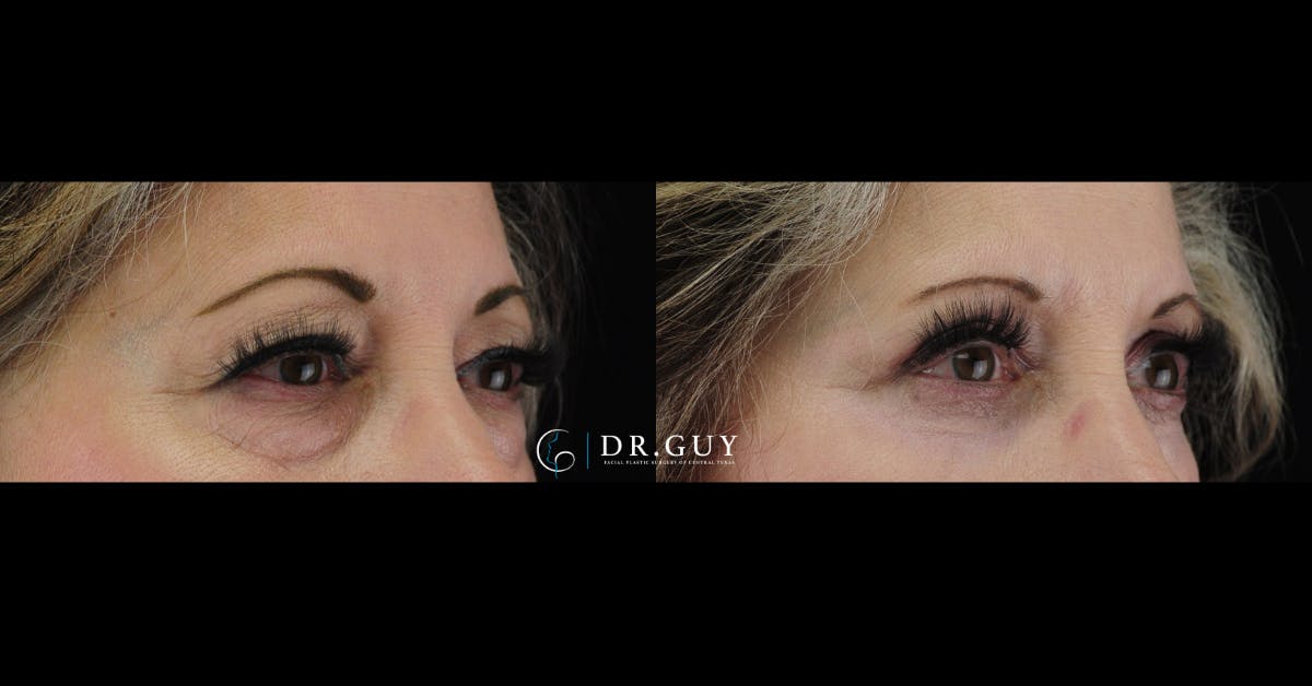 Upper Blepharoplasty Before & After Gallery - Patient 246240 - Image 2