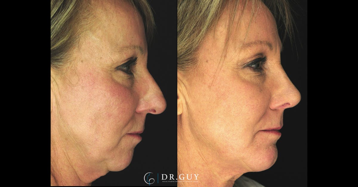 Surgical Rhinoplasty Before & After Gallery - Patient 298745 - Image 5