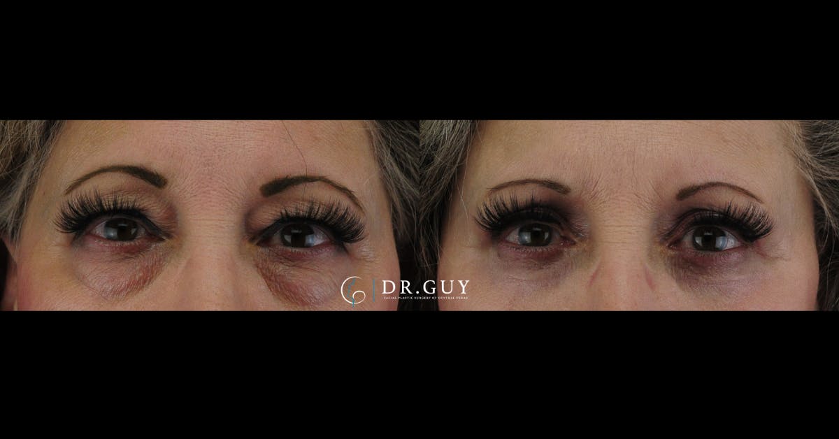 Upper Blepharoplasty Before & After Gallery - Patient 246240 - Image 3