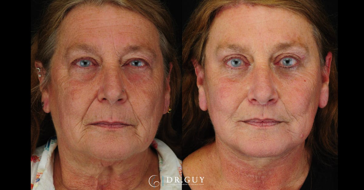 Lower Blepharoplasty Before & After Gallery - Patient 204137 - Image 1