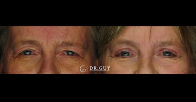 Upper Blepharoplasty Before & After Gallery - Patient 383209 - Image 1