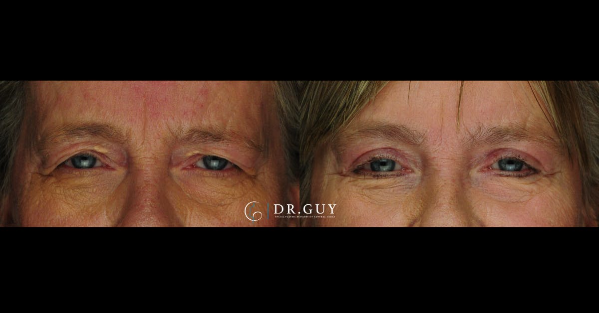 Upper Blepharoplasty Before & After Gallery - Patient 383209 - Image 1