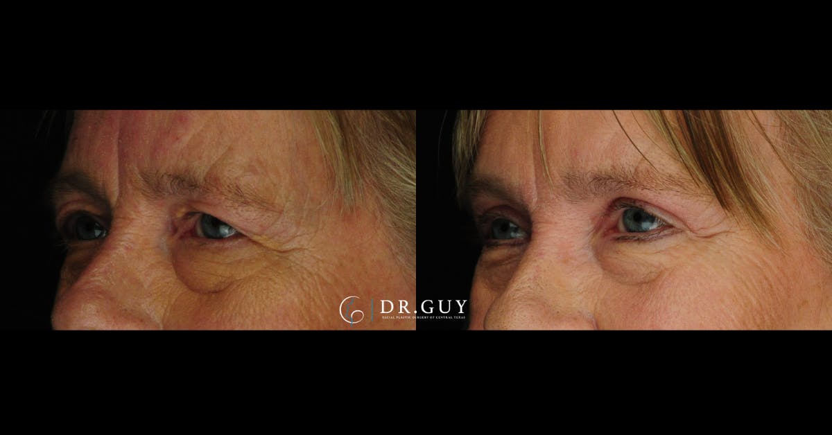 Upper Blepharoplasty Before & After Gallery - Patient 383209 - Image 2