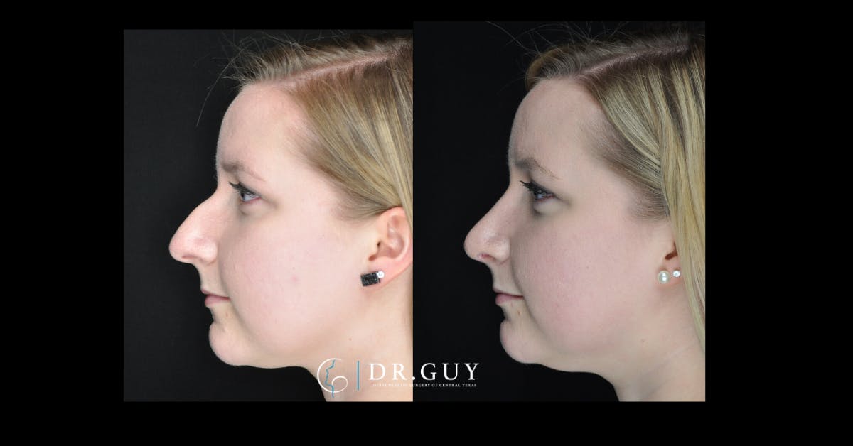 Surgical Rhinoplasty Before & After Gallery - Patient 170208 - Image 2