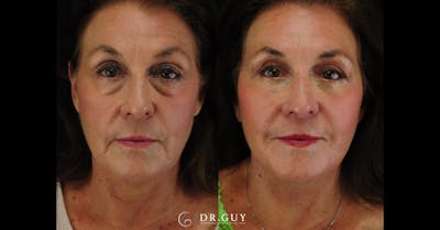 Lower Blepharoplasty Before & After Gallery - Patient 492322 - Image 1
