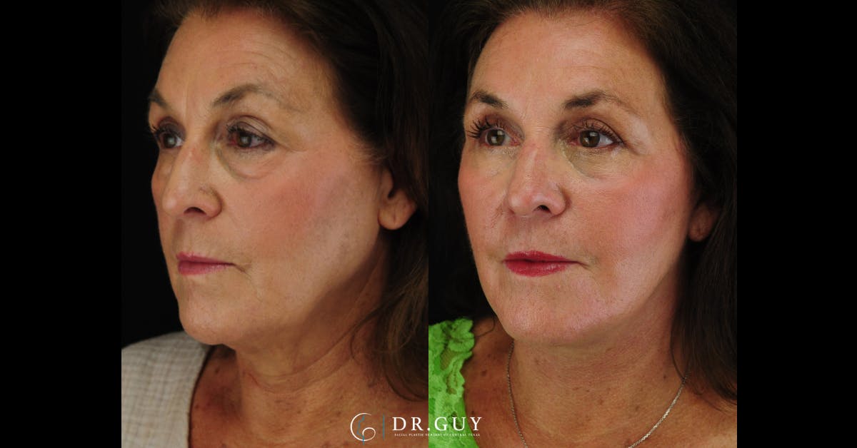 Lower Blepharoplasty Before & After Gallery - Patient 492322 - Image 2