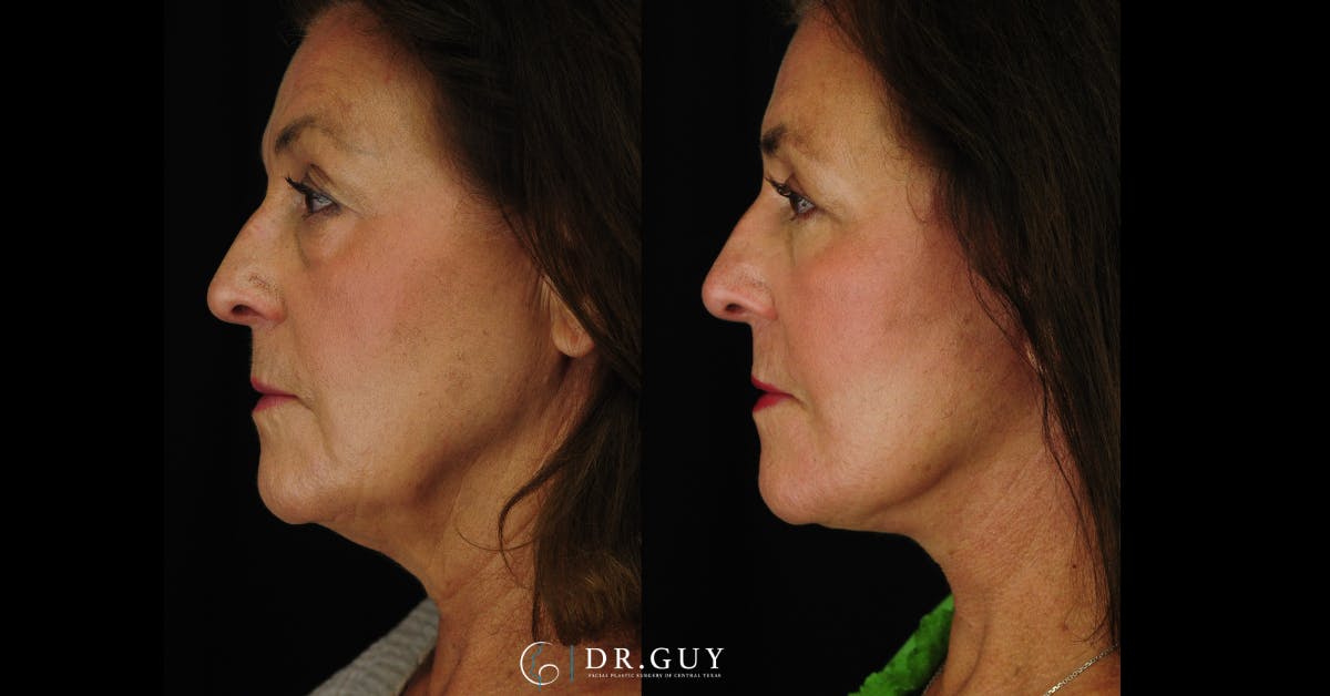 Lower Blepharoplasty Before & After Gallery - Patient 492322 - Image 3