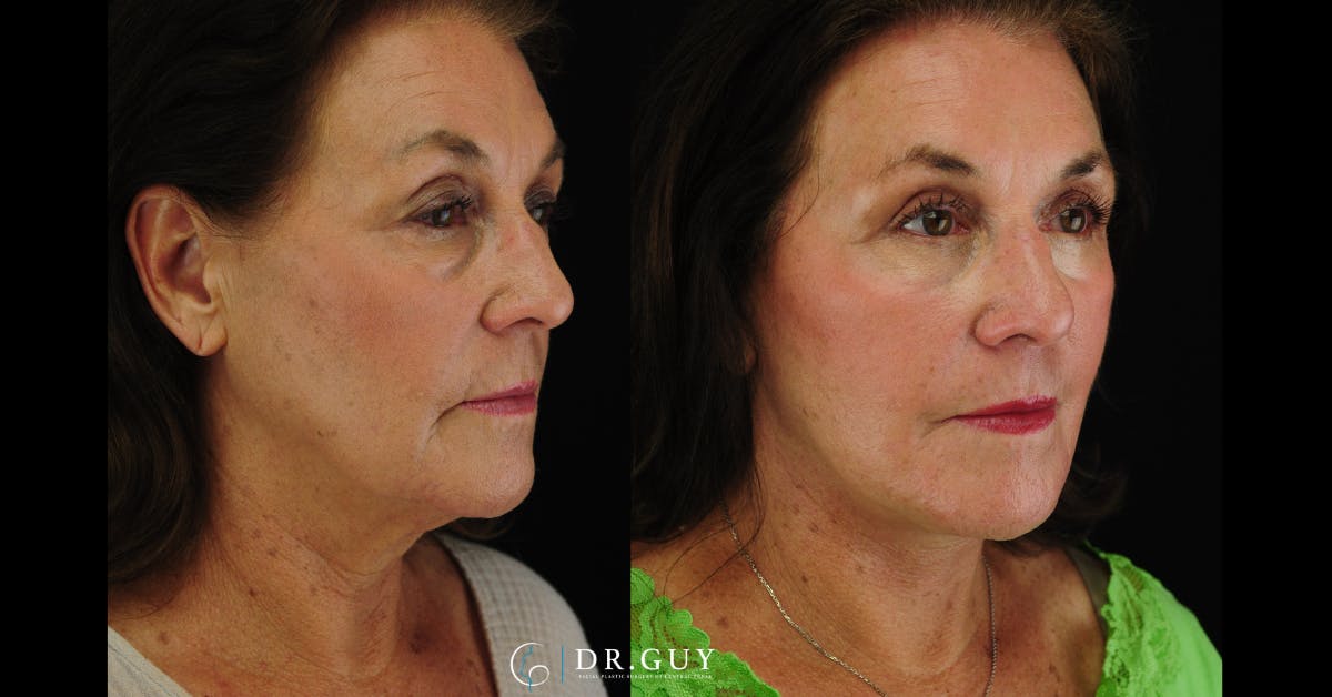 Lower Blepharoplasty Before & After Gallery - Patient 492322 - Image 4