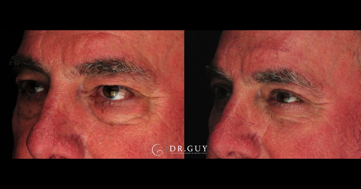 Browlift Before & After Gallery - Patient 138424 - Image 1