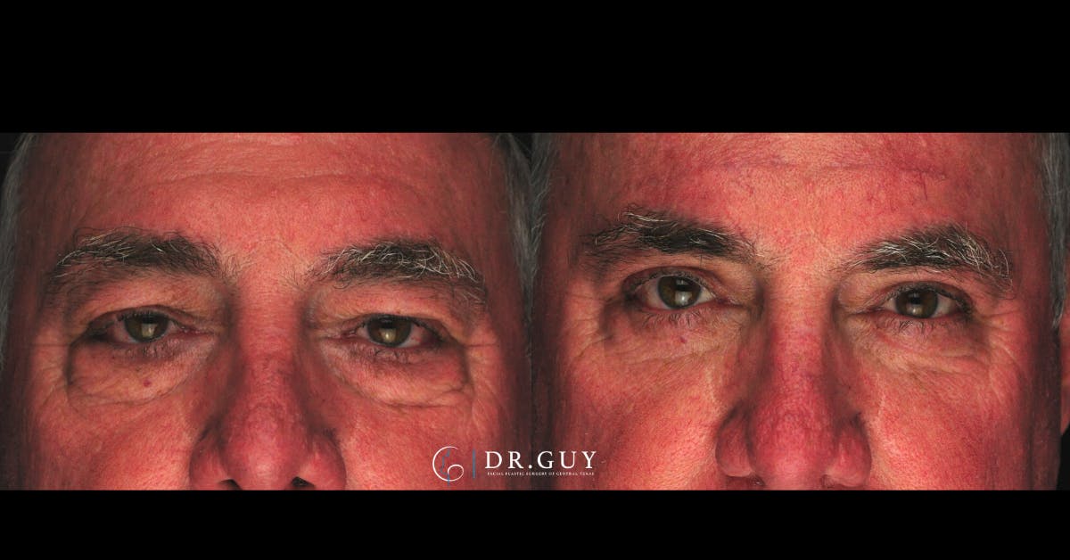 Browlift Before & After Gallery - Patient 138424 - Image 3
