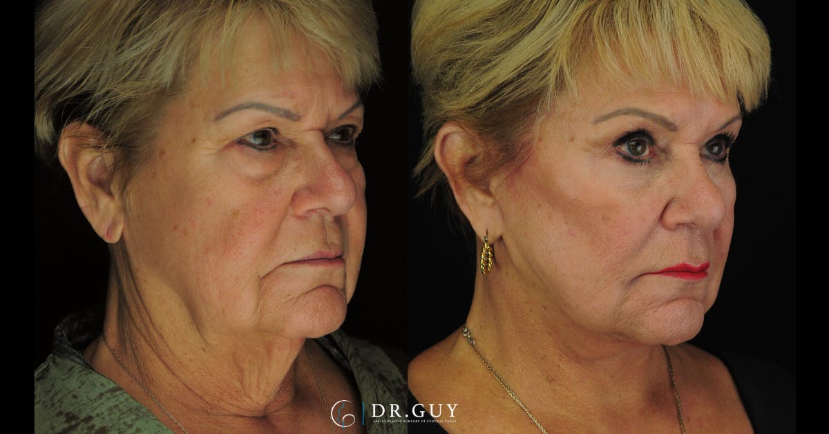 Lower Blepharoplasty Before & After Gallery - Patient 303296 - Image 4
