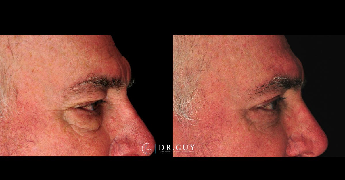 Browlift Before & After Gallery - Patient 138424 - Image 5