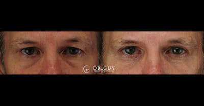 Lower Blepharoplasty Before & After Gallery - Patient 206682 - Image 1