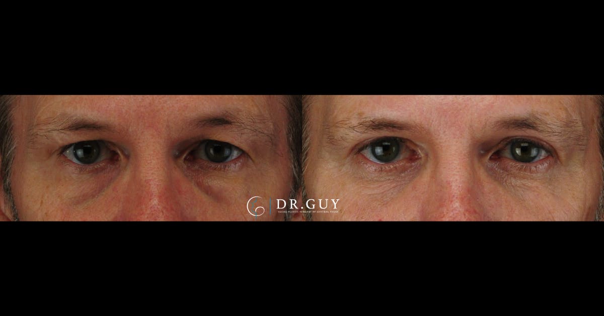 Lower Blepharoplasty Before & After Gallery - Patient 206682 - Image 1