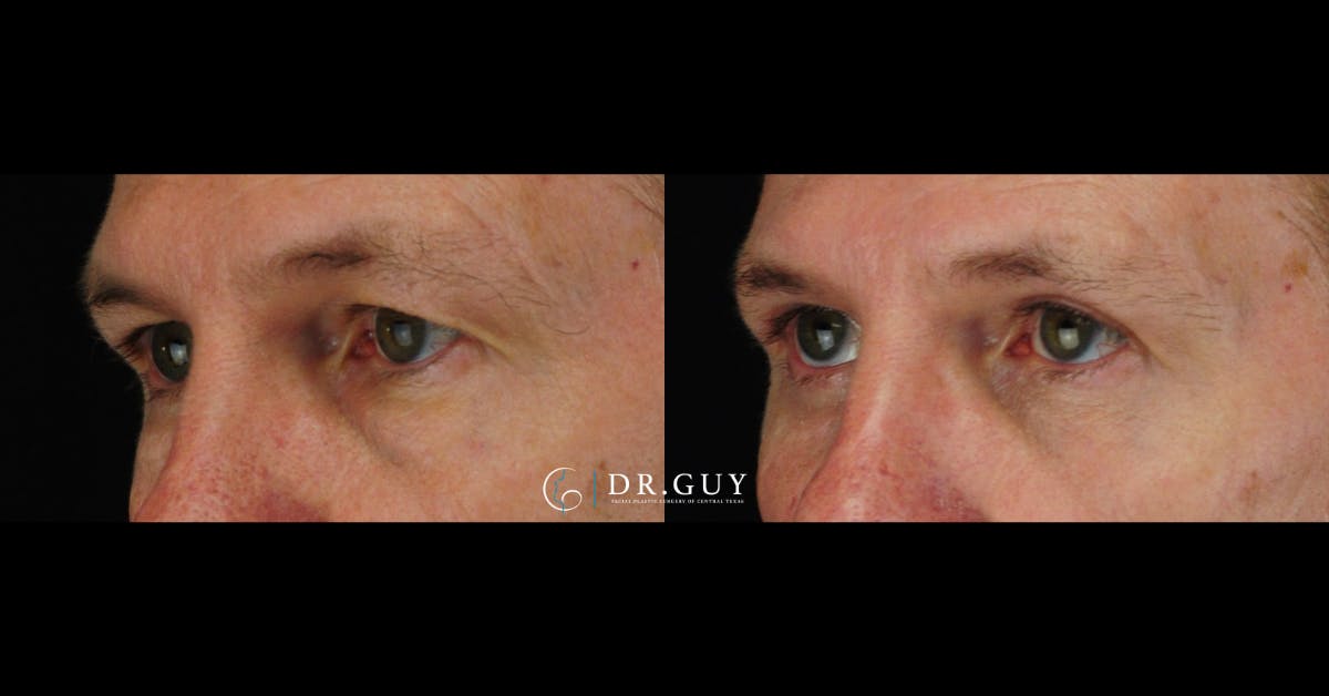 Lower Blepharoplasty Before & After Gallery - Patient 206682 - Image 2