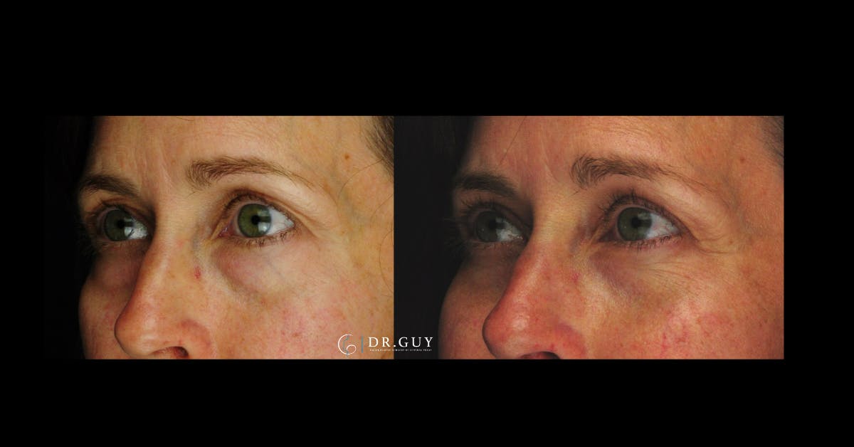 Lower Blepharoplasty Before & After Gallery - Patient 201537 - Image 1