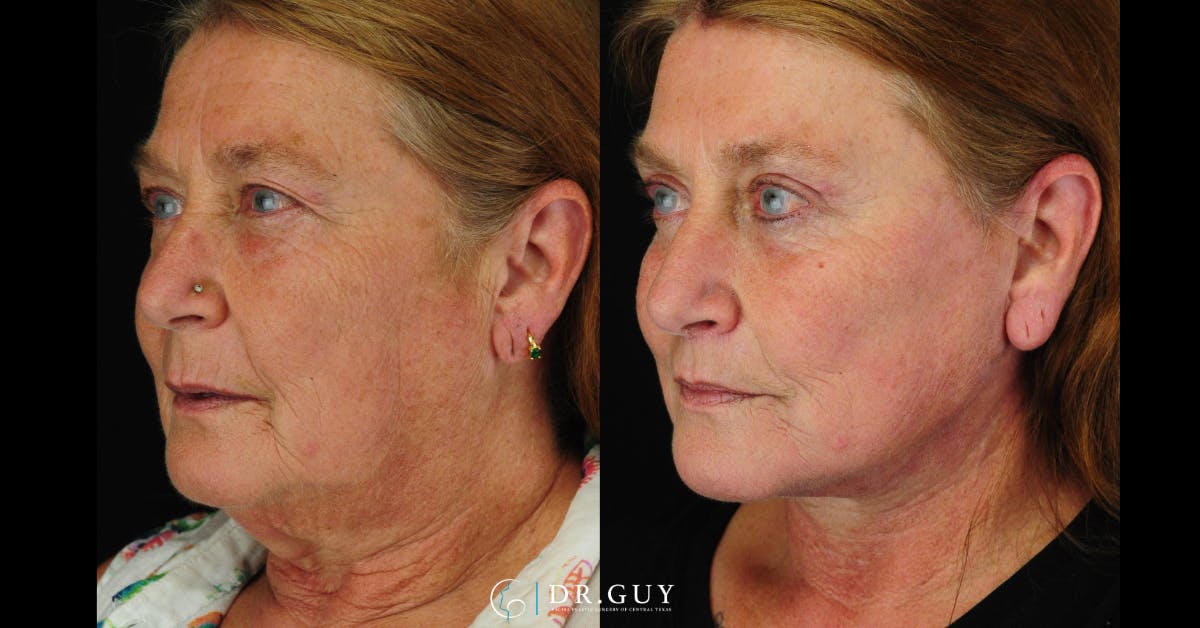 Upper Blepharoplasty Before & After Gallery - Patient 149206 - Image 2