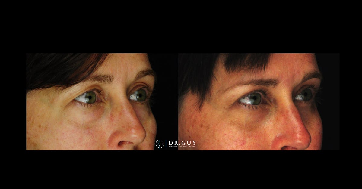 Lower Blepharoplasty Before & After Gallery - Patient 201537 - Image 2