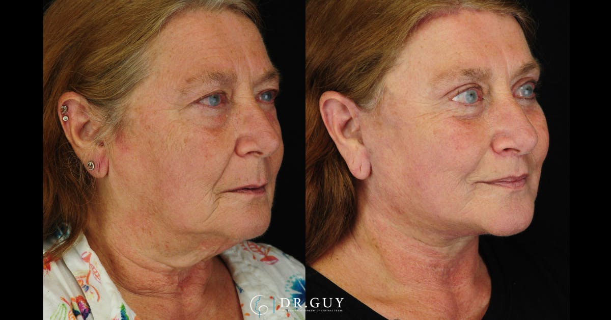 Upper Blepharoplasty Before & After Gallery - Patient 149206 - Image 3