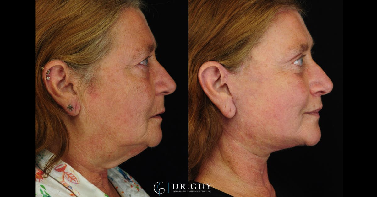 Upper Blepharoplasty Before & After Gallery - Patient 149206 - Image 4