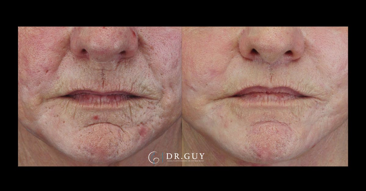 Scar Revision Before & After Gallery - Patient 277683 - Image 1