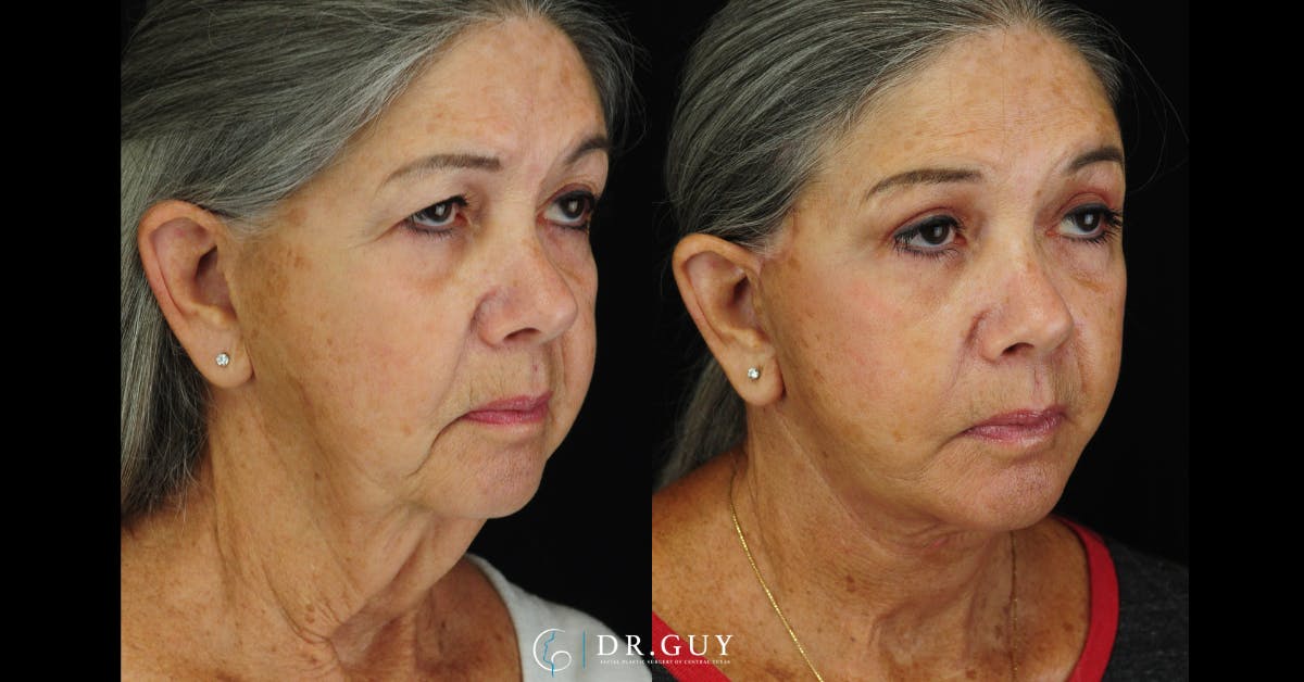 Upper Blepharoplasty Before & After Gallery - Patient 411047 - Image 2