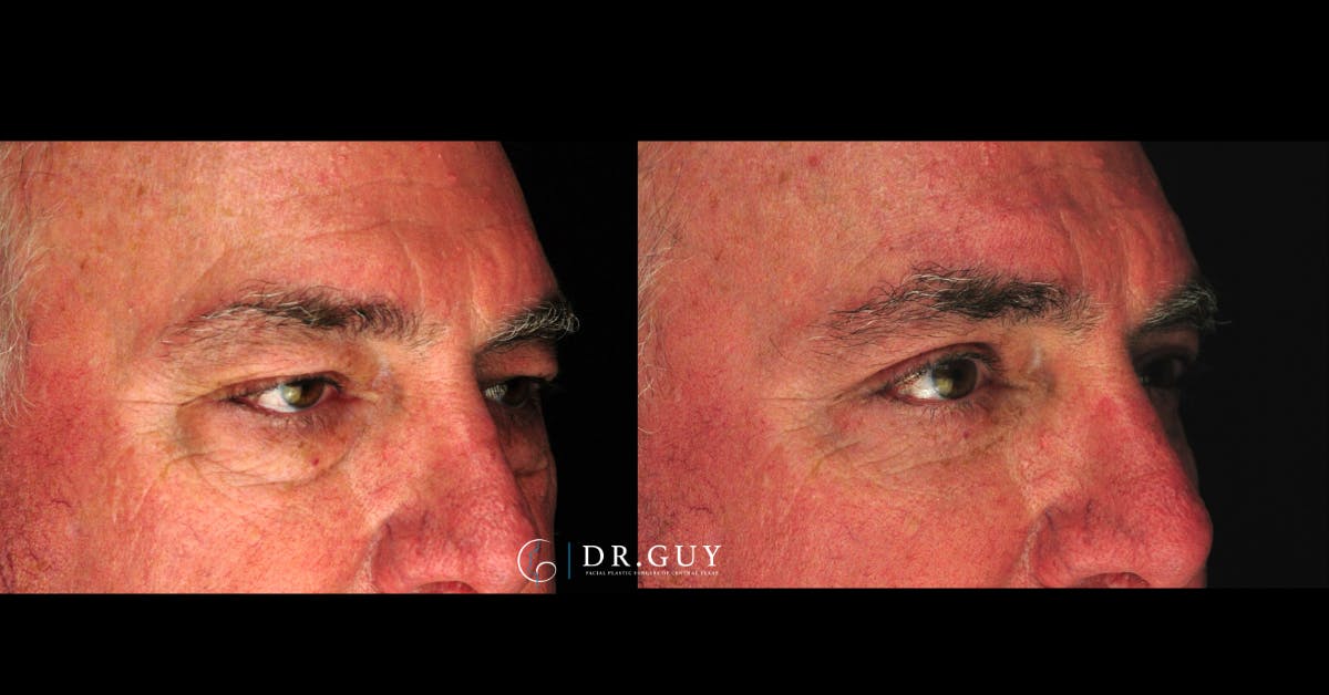 Lower Blepharoplasty Before & After Gallery - Patient 202920 - Image 2