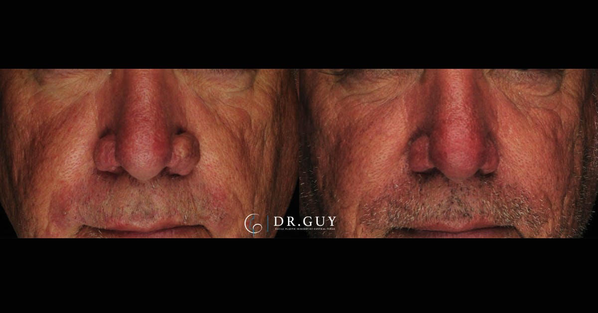 Rhinophyma Before & After Gallery - Patient 279264 - Image 1