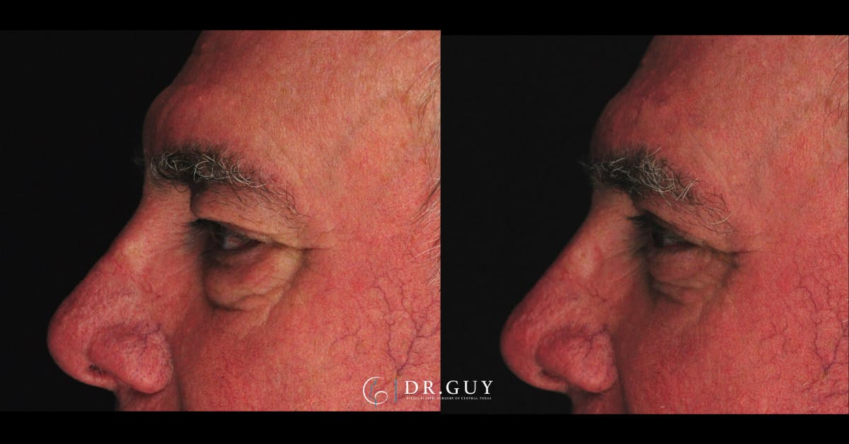 Lower Blepharoplasty Before & After Gallery - Patient 202920 - Image 4