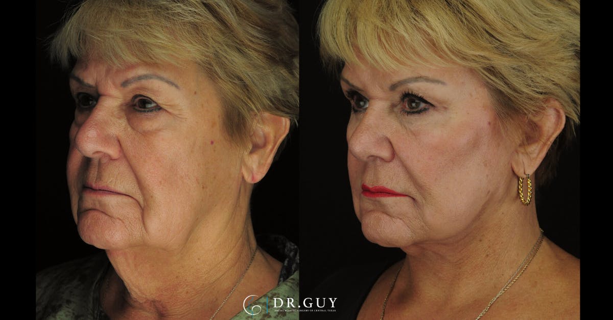 Upper Blepharoplasty Before & After Gallery - Patient 179621 - Image 2
