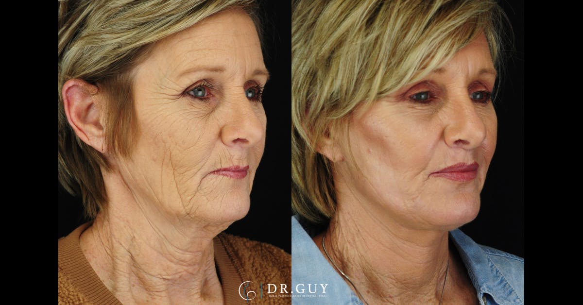 Laser Before & After Gallery - Patient 338458 - Image 3