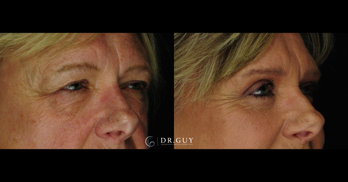 Fat Grafting Before & After Gallery - Patient 102772 - Image 4