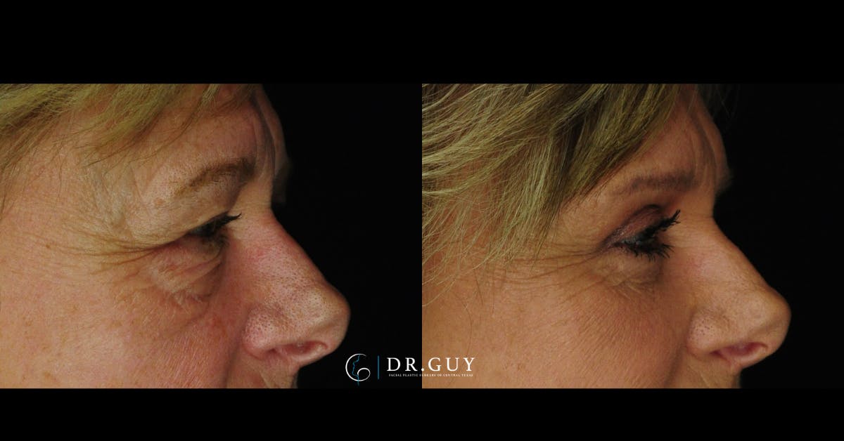 Fat Grafting Before & After Gallery - Patient 102772 - Image 5