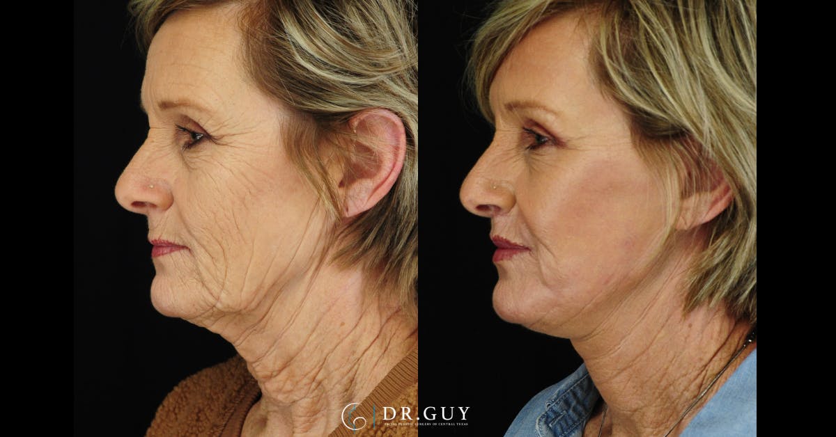 Laser Before & After Gallery - Patient 338458 - Image 5