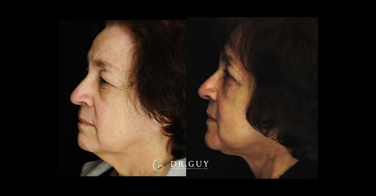 Fat Grafting Before & After Gallery - Patient 142198 - Image 2