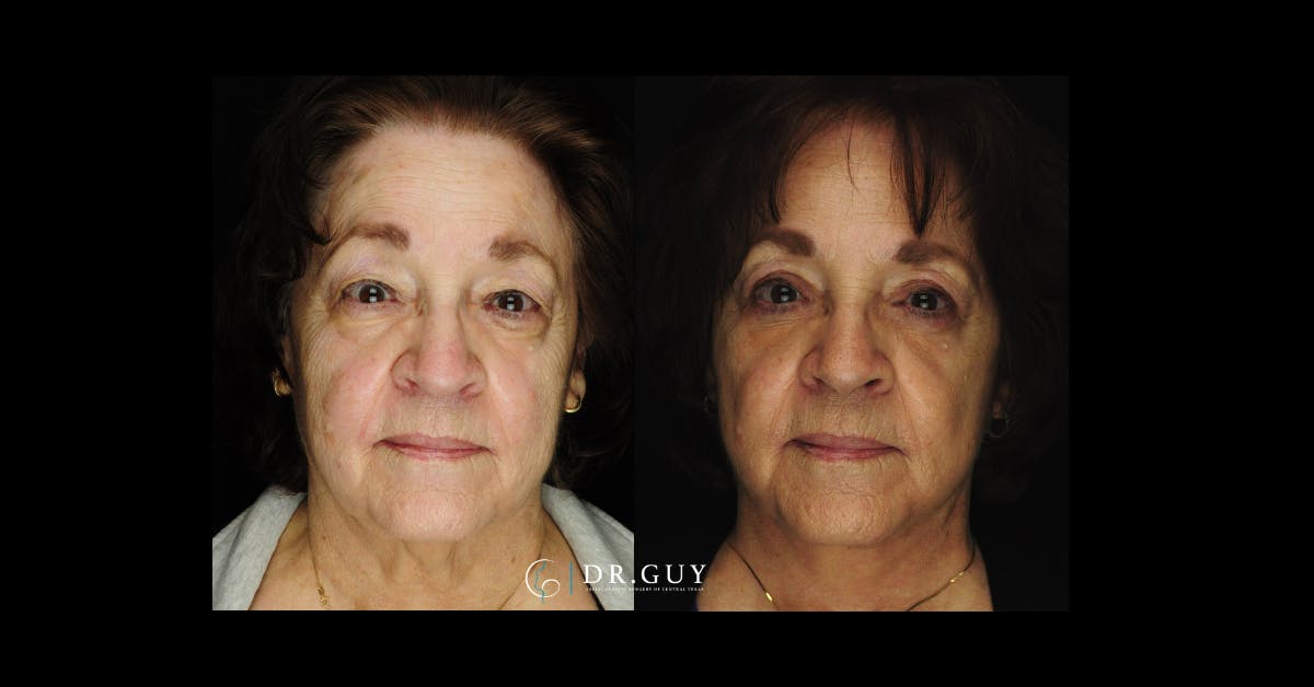 Fat Grafting Before & After Gallery - Patient 142198 - Image 3