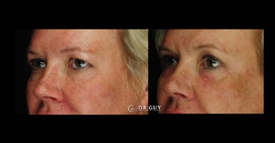 Chemical Peels Before & After Gallery - Patient 215625 - Image 1