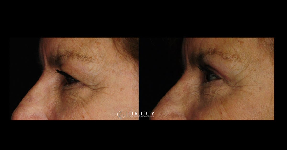 Upper Blepharoplasty Before & After Gallery - Patient 235735 - Image 2