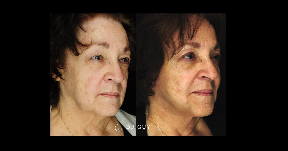 Fat Grafting Before & After Gallery - Patient 142198 - Image 4