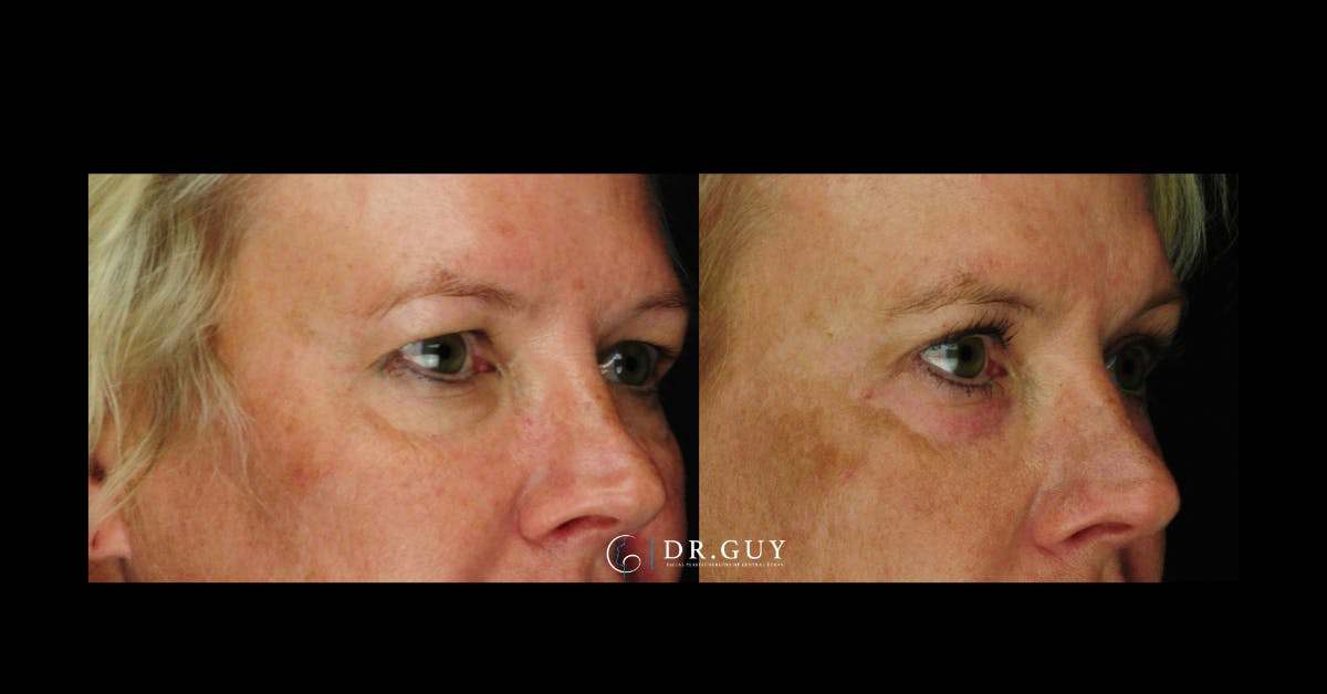 Chemical Peels Before & After Gallery - Patient 215625 - Image 2