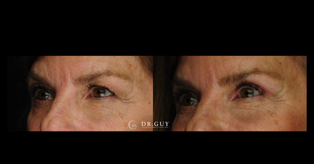 Upper Blepharoplasty Before & After Gallery - Patient 235735 - Image 3