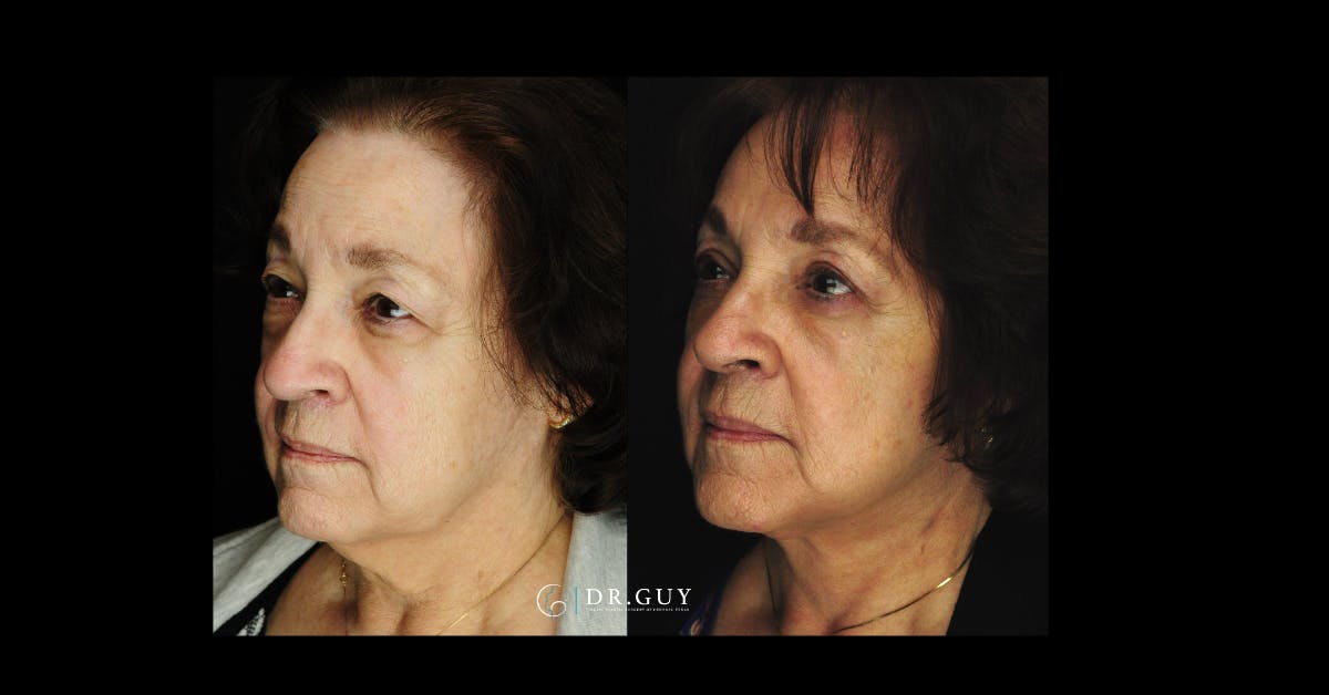 Fat Grafting Before & After Gallery - Patient 142198 - Image 5