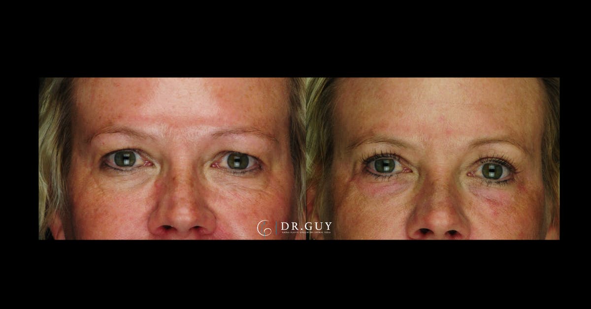 Chemical Peels Before & After Gallery - Patient 215625 - Image 3