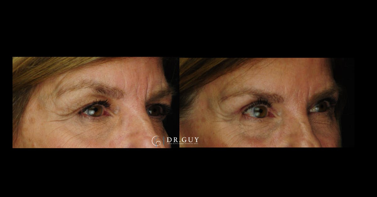 Upper Blepharoplasty Before & After Gallery - Patient 235735 - Image 4