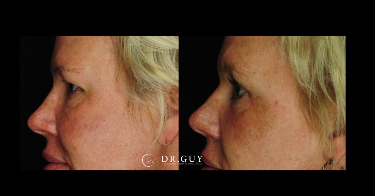 Chemical Peels Before & After Gallery - Patient 215625 - Image 4