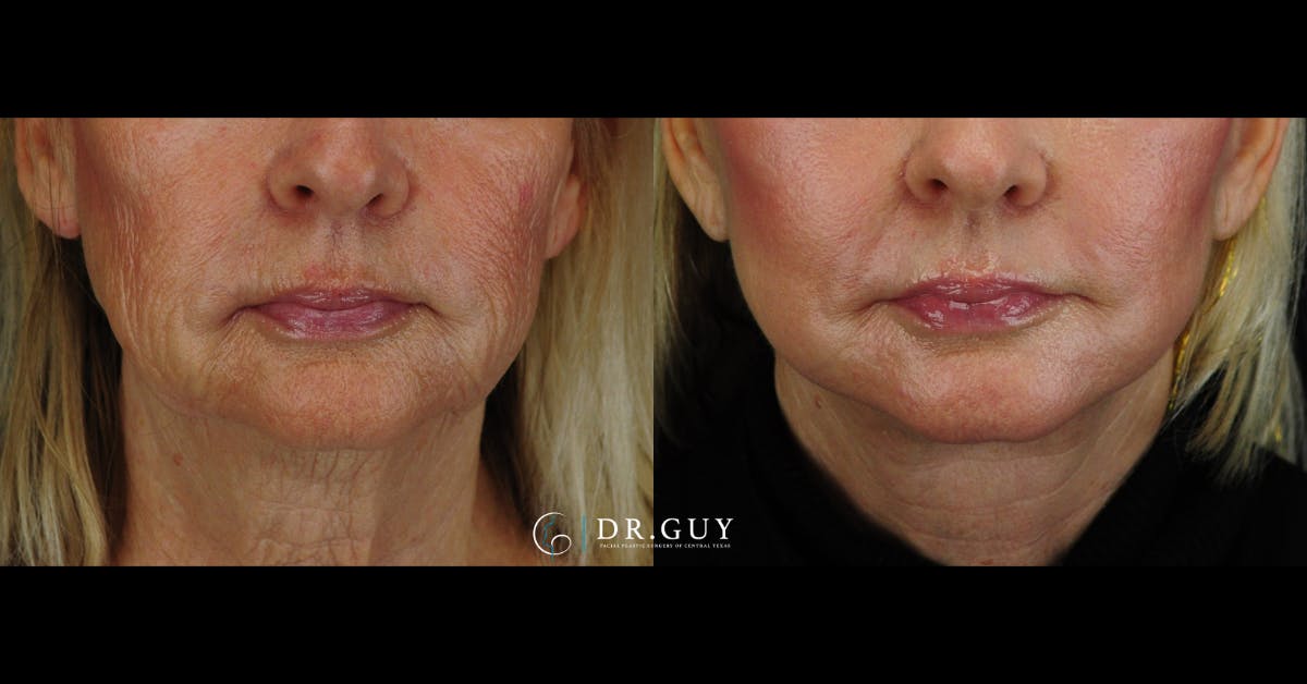 Laser Before & After Gallery - Patient 180288 - Image 3