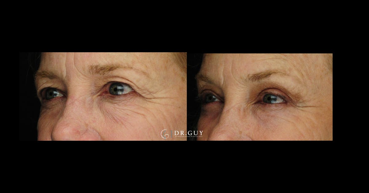 Upper Blepharoplasty Before & After Gallery - Patient 322359 - Image 1