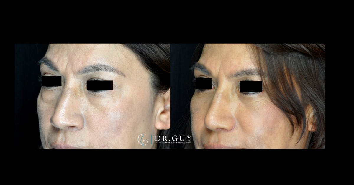 Fat Grafting Before & After Gallery - Patient 191699 - Image 1